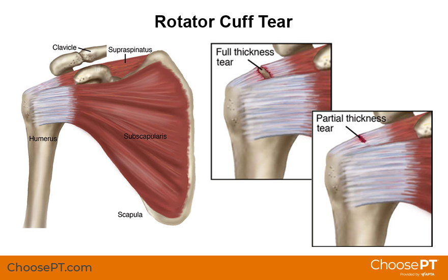 Rotator Cuff Tendon Tear
